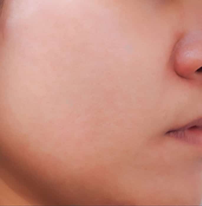 skinn